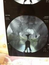 内行人说下，试管前吃芬吗通是什么方案？